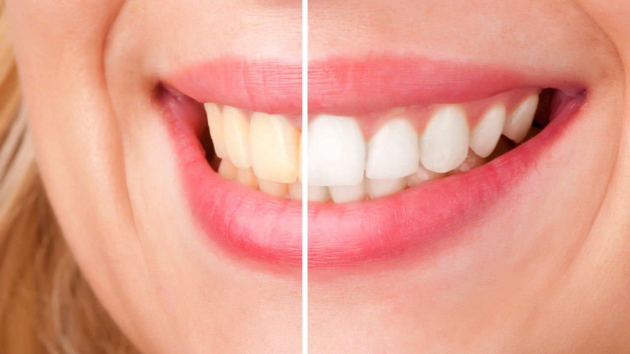 Clareamento dental: mitos, verdades e cuidados para um sorriso mais branco